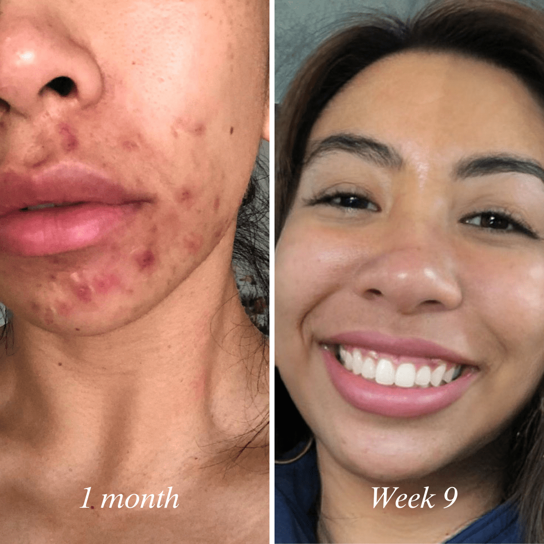 Clear 90™ (3 - Months) by Amaka – supplement