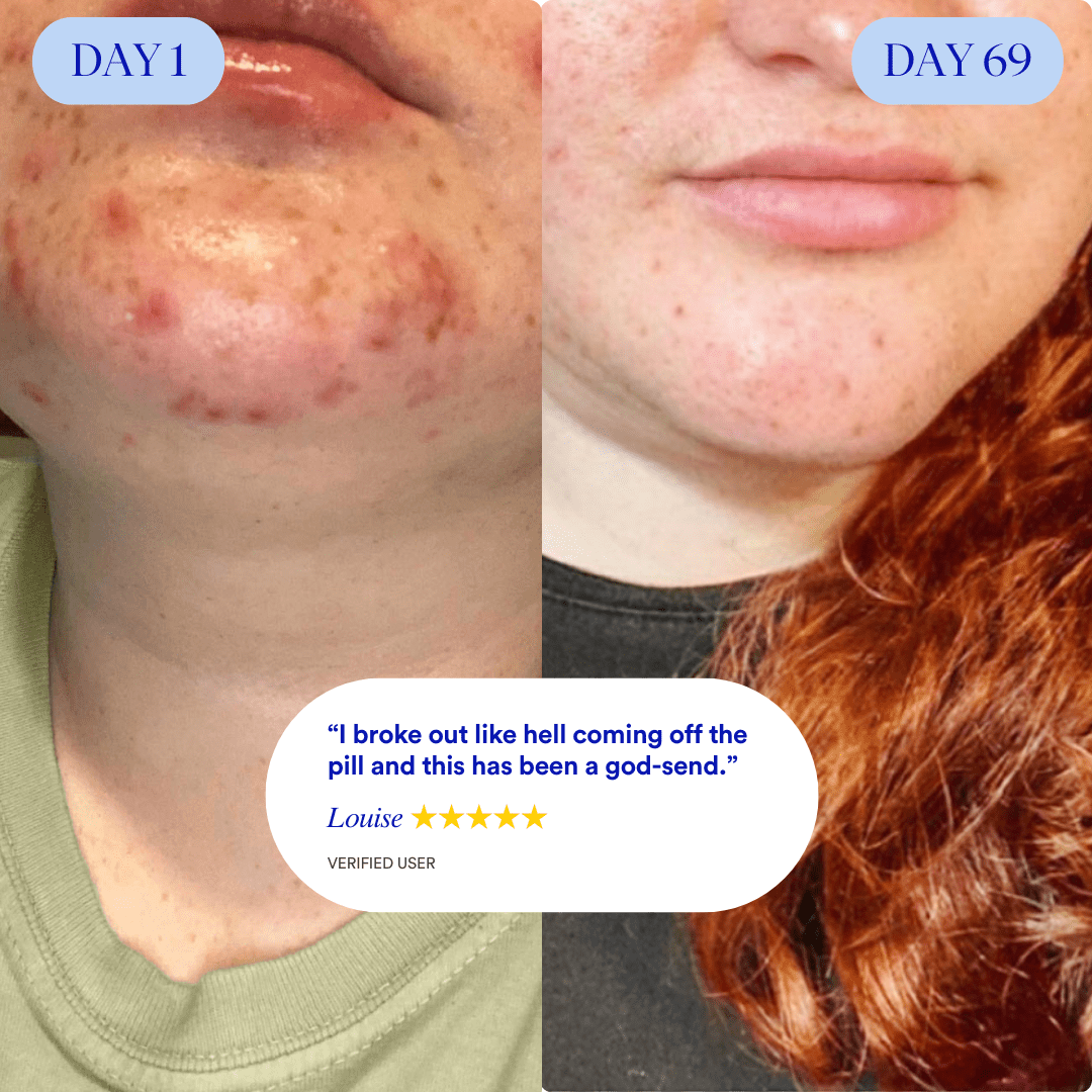 Clear 90™ (3 - Months) by Amaka – supplement