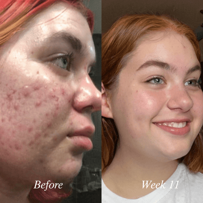 Clear 90™ (3 - Months) by Amaka – supplement